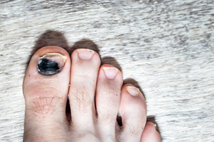 What Causes Runner’s Toenail?